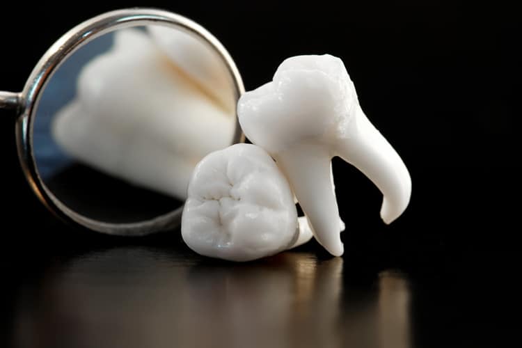 Wisdom Tooth Removal | Impression Dental