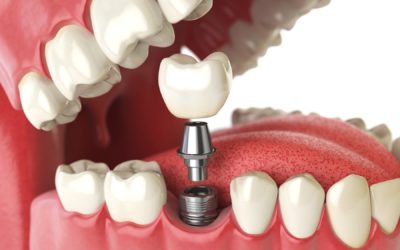 six interesting facts about dental implants