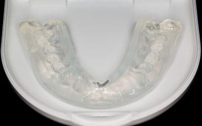 frequently asked questions about invisalign
