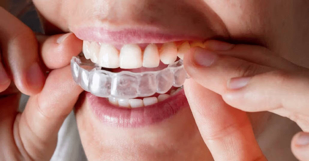 why-do-my-teeth-feel-weird-after-invisalign-impression-dental