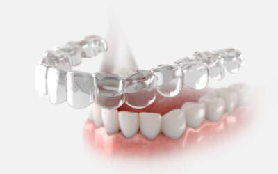 What to Expect When Getting Invisalign: Your Step-by-Step Guide